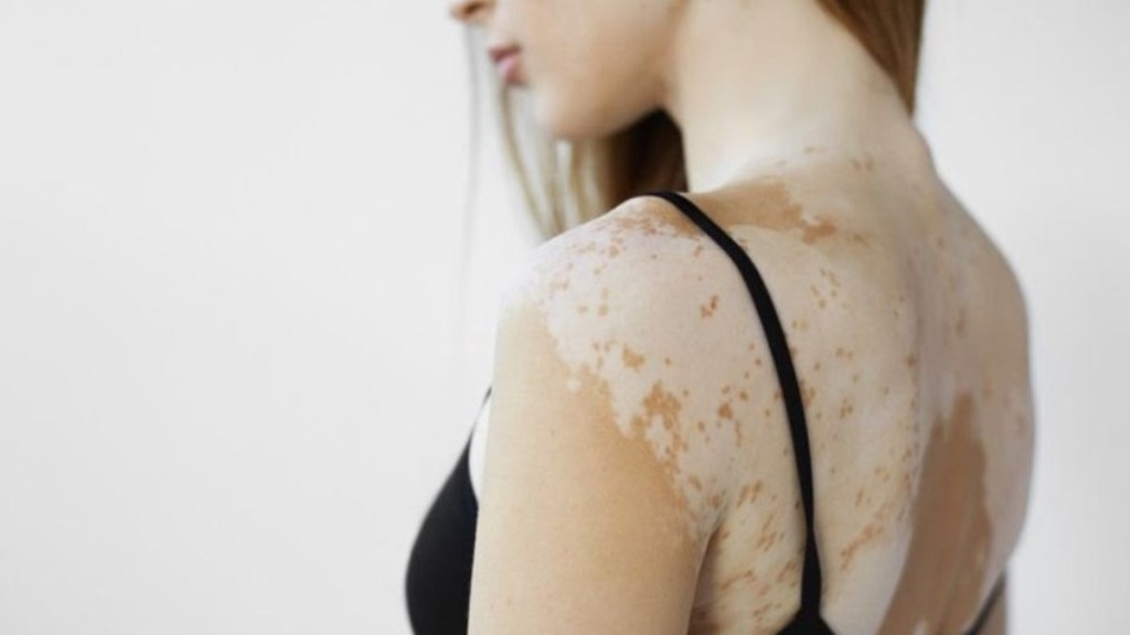 Redação GPS Vitiligo: confira dicas de cuidados especiais com a pele